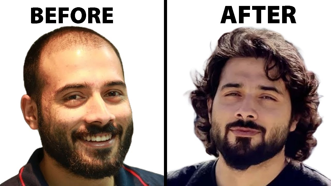 My Remarkable Hair Transplant Journey | Hair Surgeon Reacts