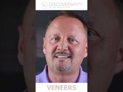 Veneers Vorher Nachher #veneers #zähne #zahnarzt #weißezähne