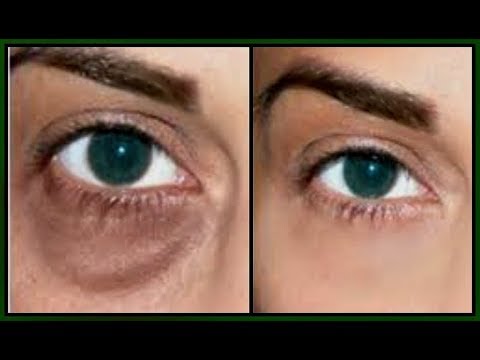 QUICK FIX FOR UNDER EYE BAGS, DARK CIRCLES PUFFY EYES AND TIRED EYES The result is amazing Khichi Be