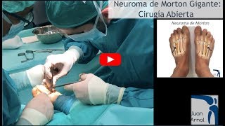 Cirugía Neuroma de Morton Gigante