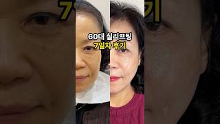 실 리프트 성형 시술
