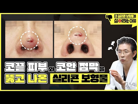 사례와 함께 알아보는 내가 코 실리콘 보형물을 싫어하는 이유 #1 #코보형물제거 #코실리콘제거 #코재수술