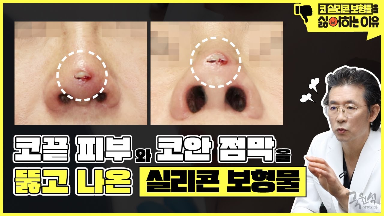 사례와 함께 알아보는 내가 코 실리콘 보형물을 싫어하는 이유 #1 #코보형물제거 #코실리콘제거 #코재수술 썸네일