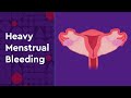 Heavy Menstrual Bleeding And Available Treatment For Teens