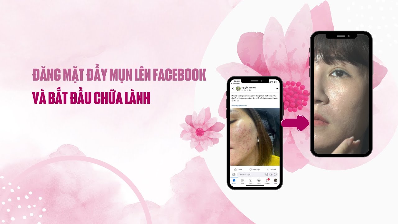 Đăng mặt đầy mụn lên facebook và bắt đầu chữa lành