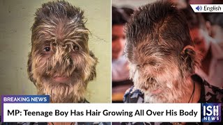 MP: Teenage Boy Has Hair Growing All Over His Body