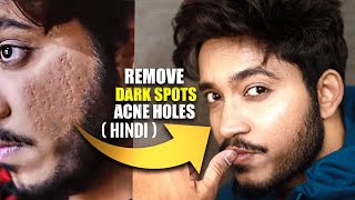 How To Remove Dark Spots & Acne Holes | Naturally | Remove Acne Marks Fast