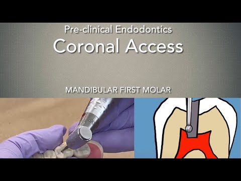 Dostęp endodontyczny - pierwszy trzonowiec żuchwy