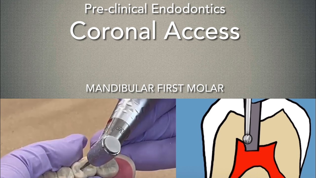 Coronal Access (Mandibular First Molar)