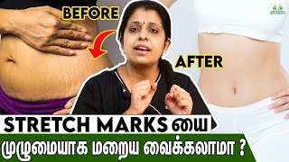 How to Remove Stretch Marks | Dr Deepthi Jammi, Cwc | Home Remedies Tamil, Post Pregnancy Problems