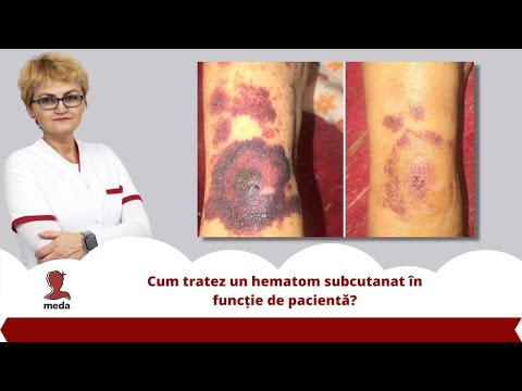 hematoma dupa vene varicoase