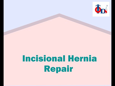 Darning with Mesh Repair of Hernia | Laparoscopic Hernia Surgery using Darning with Mesh Repair