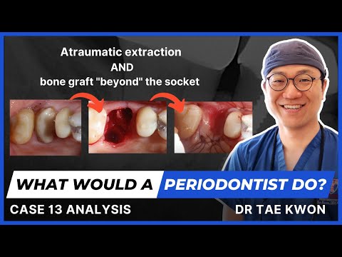 What Would A Periodontist Do? With Dr Tae Kwon - Case 13