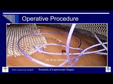 Reparación laparoscópica de hernia ventral