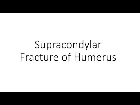 Supracondylar Fracture of Humerus - Orthopedics