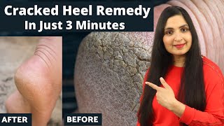 Get Rid of CRACKED HEELS Permanently - 3 MINUTE REMEDY / Magical Cracked Heels Home Remedy / #Remedy