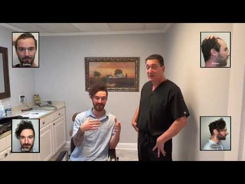 Dr. Brett Bolton Patient Casey FUE Correction