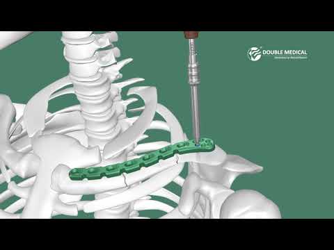 Double Medical Superior Anterior Distal Clavicle Locking Plate