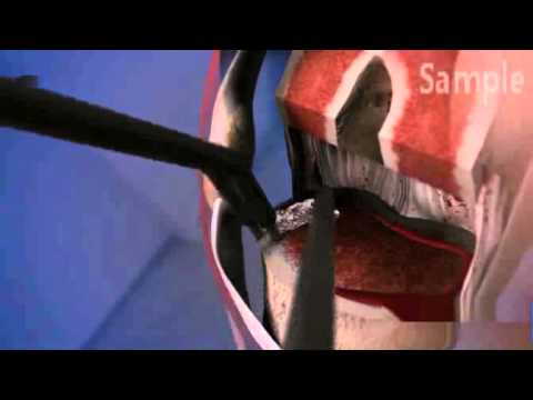 3D Animation: Insertation einer Knieprothese