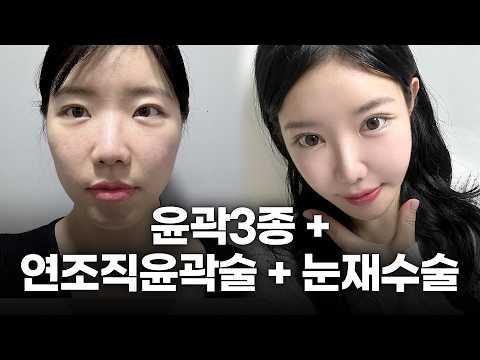 레이저로 안 되는 처진 살+옆볼패임? 윤곽 3종이랑 연조직 윤곽술 같이 하고 6개월 만에 10년 젊어진 리얼 성형 브이로그 (디에이성형외과)