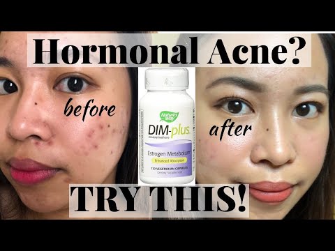 DIM SUPPLEMENT FOR HORMONAL ACNE | EFFECTIVE TALAGA!
