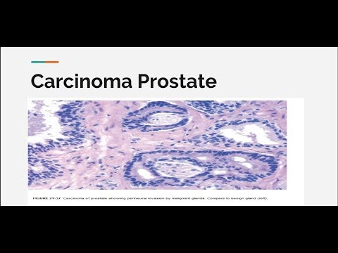 Prostatitis hamstring pain