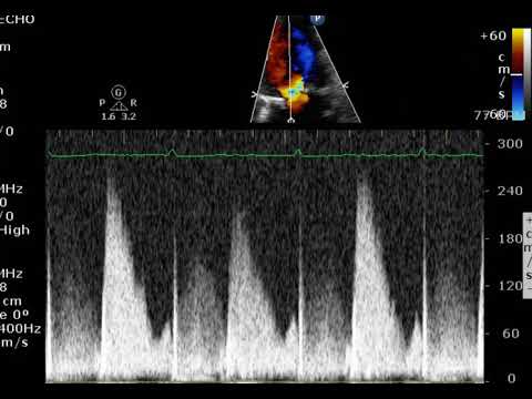 PHT with a Bio Valve