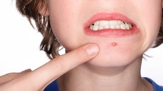 How to Deal with Acne Pain | Acne Treatment