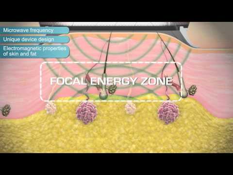 miraDry. The Lasting Treatment for Excessive Underarm Sweat or Axillary Hyperhidrosis