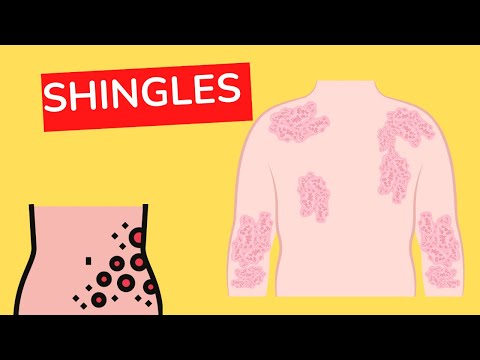 What is Shingles | Herpes Zoster | Nervesmedicine