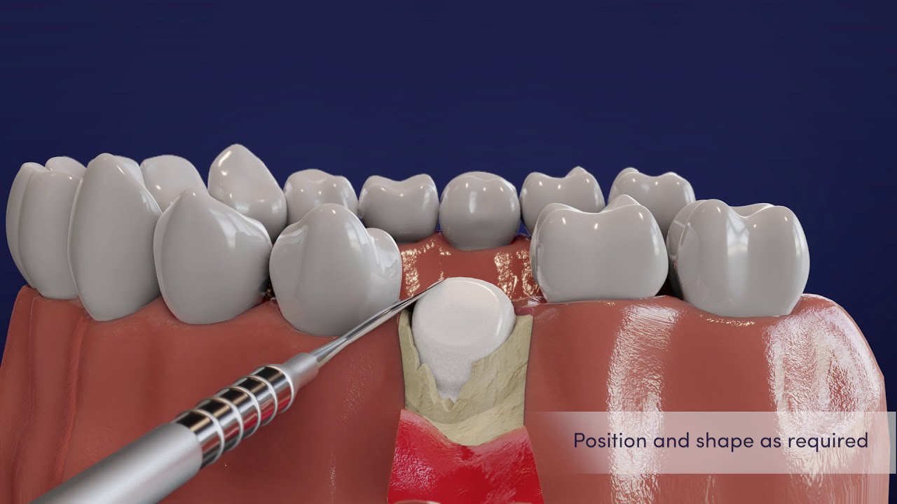 How to Prepare and Place EthOss Instructional Explainer Animated Video