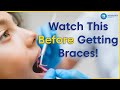 What To Know Before Getting Braces | 8 Tips To Prepare You For Braces