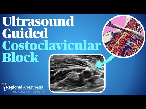 Costoclavicular Brachial Plexus Block