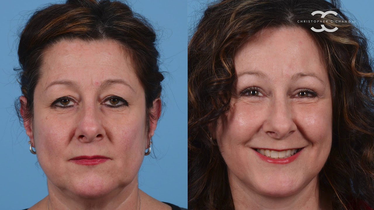 Facelift in Washington DC at Congressional Plastic Surgery B&A