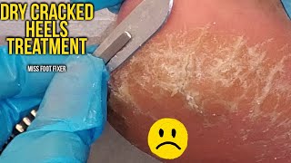 Get Rid of Your Dry Cracked Heels - How to Treat Cracked Heels Full Treatment by miss foot fixer