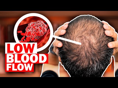 What REALLY Causes Hair Loss? (And What To Do About It!)