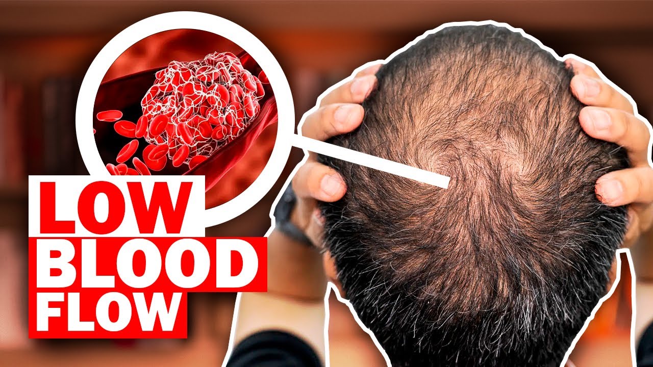 What REALLY Causes Hair Loss? (And What To Do About It!)