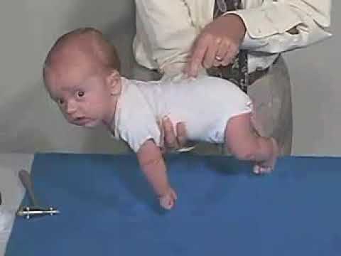 5.15 - Primitive Reflexes, Galant Reflex - 3 Months - Infant Clinical Examination (MRCP)