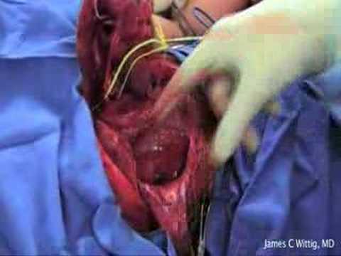 Prothèse de l'omoplate après l'ablation totale due à un sarcome d'Ewing - Partie 4