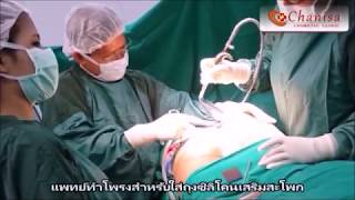 ผ่าตัดเสริมสะโพกด้วยถุงซิลิโคน