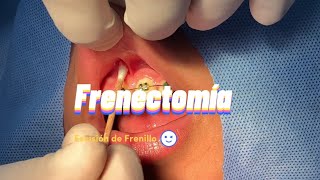Frenectomía / Frenilectomia / Escisión del Frenillo Vestibular Antero superior
