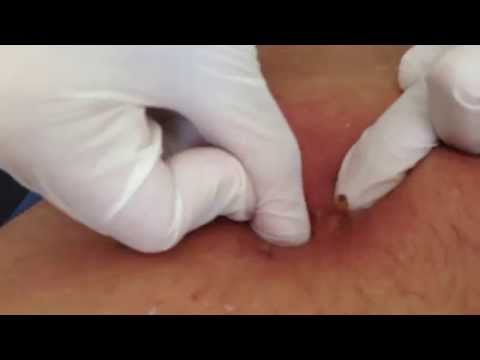 ウマバエ（ヒトヒフバエ）は日本にいる？寄生された症状や治療について | 危険生物．information