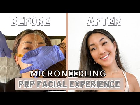 Full PRP Facial / Microneedling Experience + Before/After Recovery