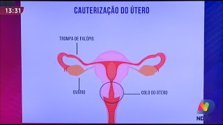 Ectopia Cervical (ferida no colo do útero) :  causas , sintomas,  tramento - Dr. Belarmino