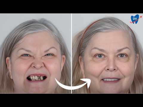 Her Review of All on 4 Dental Implants in Thailand (Depression No More!)