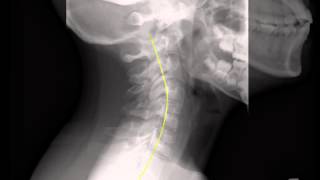 Natural relief for Headaches, Neck Pain, and Shoulder Tension