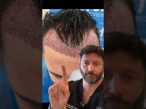 Hair restoration surgeon reacts to a bad Turkey hair transplant  #hairtransplant #hairloss