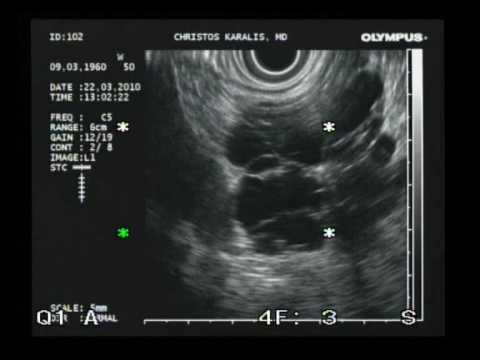 Pancreas - Cystic Neoplasm