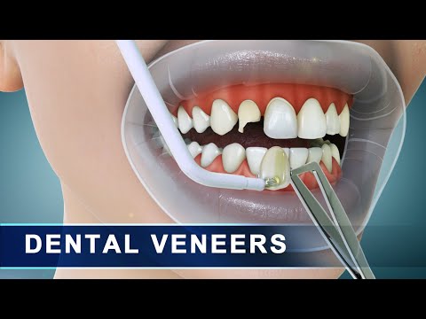 Veneers | Step by step preparation and placement of dental veneers | 3d Animation