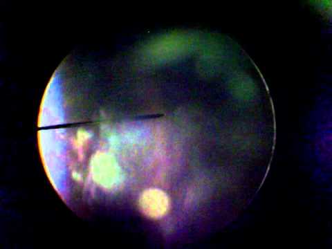 Krebsdiagnostik Prostata Pathologien der Prostata